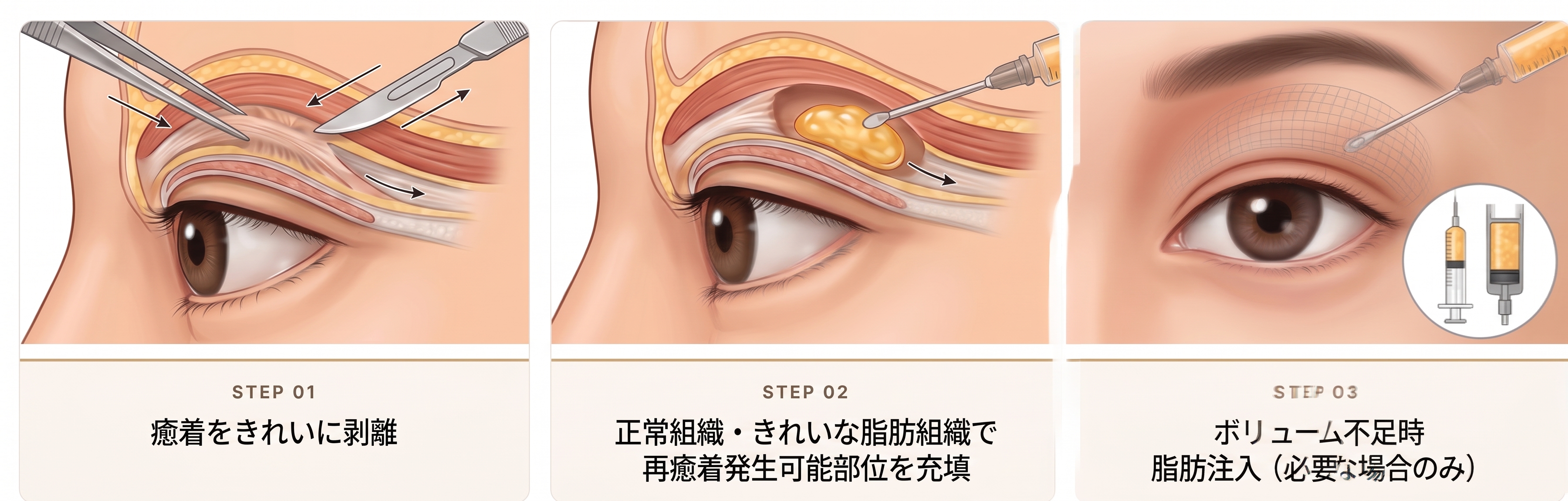 二重のラインが何重にも見えますか？悪性多重しわの原因と改善方法を徹底解説 사진 6