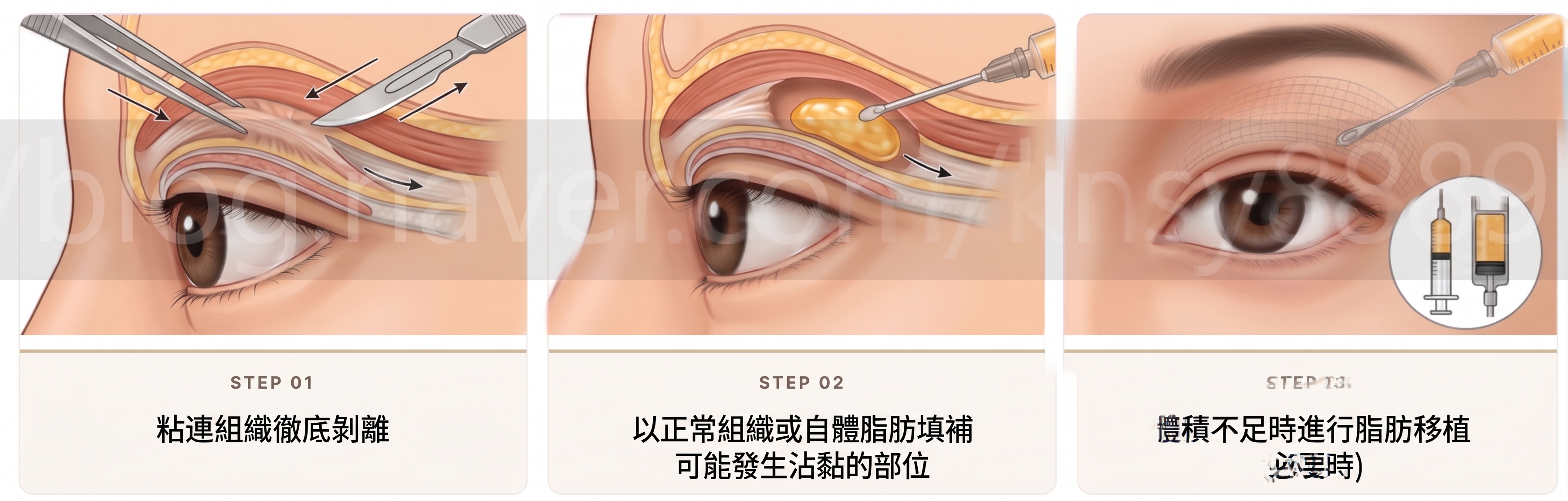 雙眼皮線條看起來有多層？惡性多層摺痕的原因與改善方法總整理 사진 6