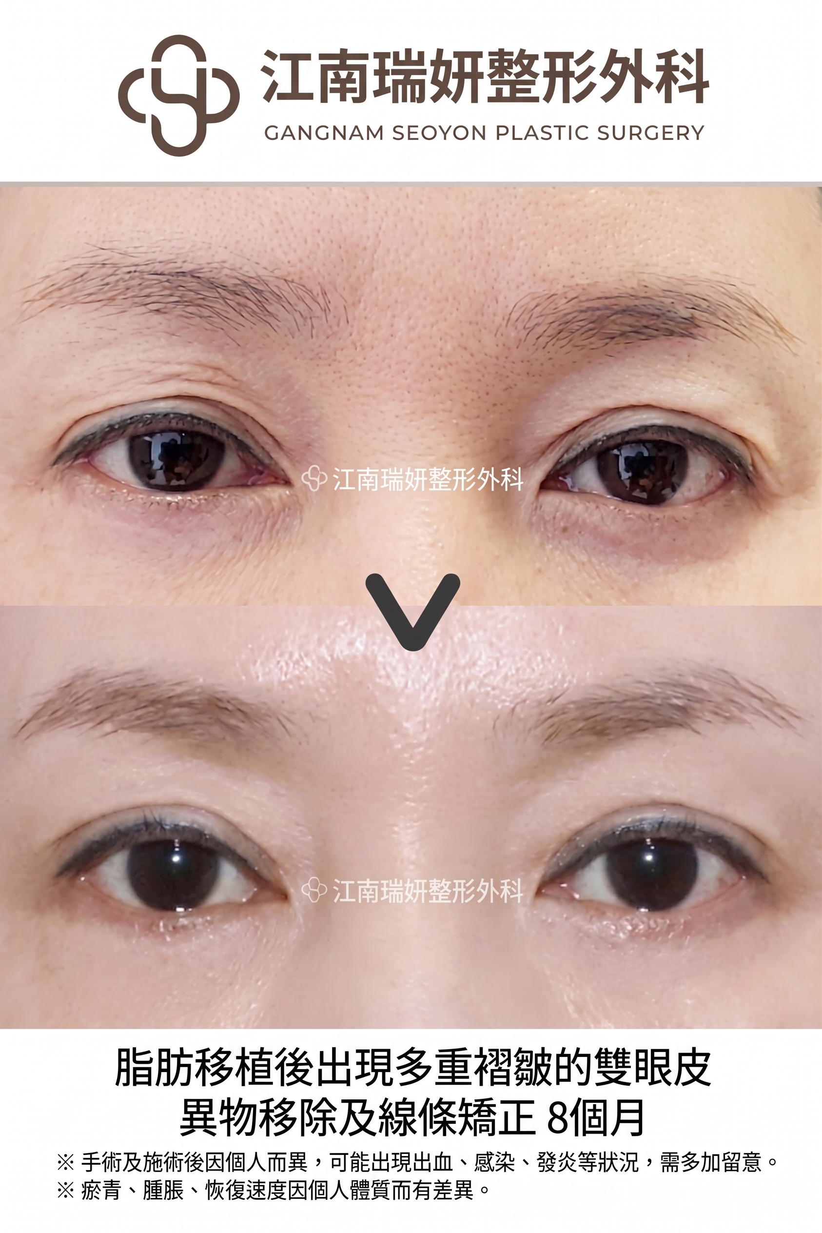雙眼皮線條看起來有多層？惡性多層摺痕的原因與改善方法總整理 사진 2