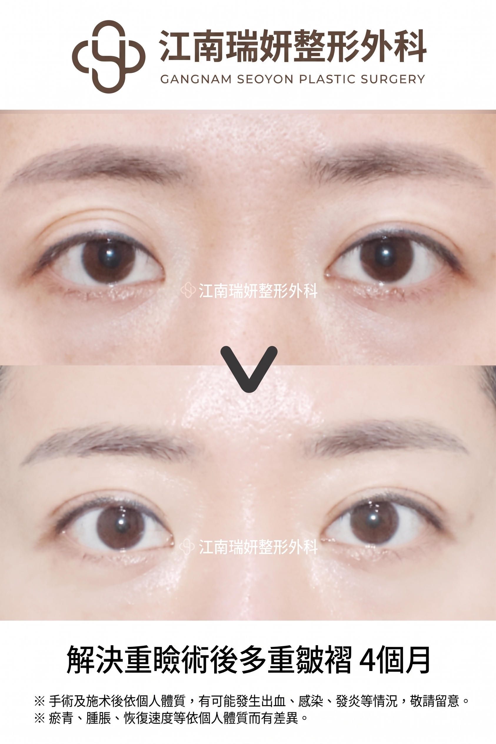 雙眼皮線條看起來有多層？惡性多層摺痕的原因與改善方法總整理 사진 4