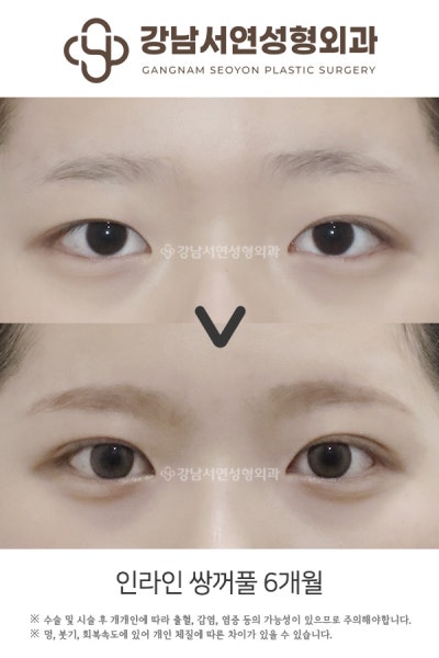 쌍꺼풀수술 매몰법 vs 절개법 차이, 첫 눈성형이라면 꼭 알아야 할 기준 사진 7