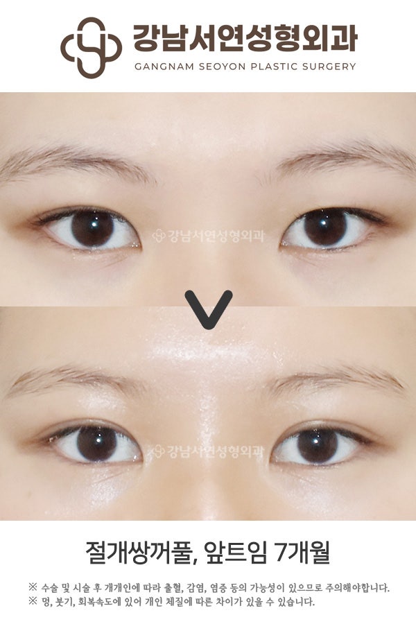 쌍꺼풀수술 매몰법 vs 절개법 차이, 첫 눈성형이라면 꼭 알아야 할 기준 사진 5