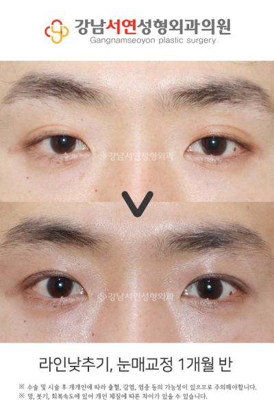 쌍꺼풀수술 vs 눈매교정, 나에게 맞는 건? 첫 눈성형 전 헷갈리는 수술 구분법 사진 4