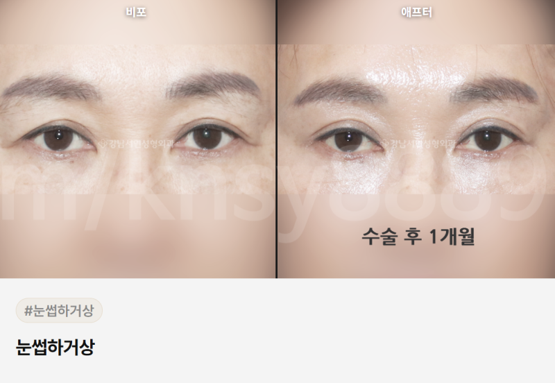 눈썹하거상 흉터, 어디에 생기고 얼마나 눈에 띄나요?