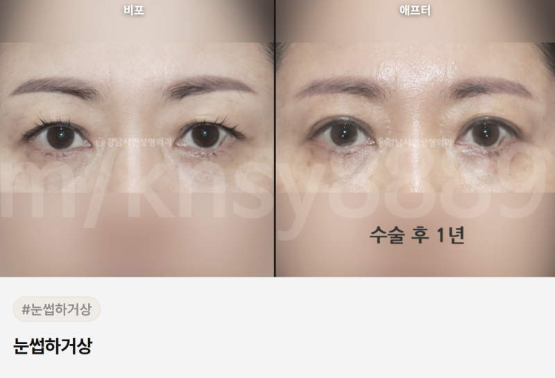 눈썹하거상 흉터, 어디에 생기고 얼마나 눈에 띄나요? 사진 6