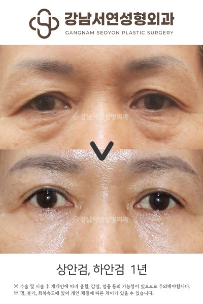 눈썹하거상 흉터, 어디에 생기고 얼마나 눈에 띄나요? 사진 5