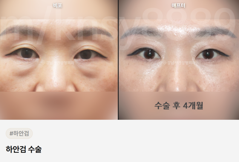 하안검 회복기간, 수술 방법별로 다릅니다 — 단계별 완전 정리 사진 4