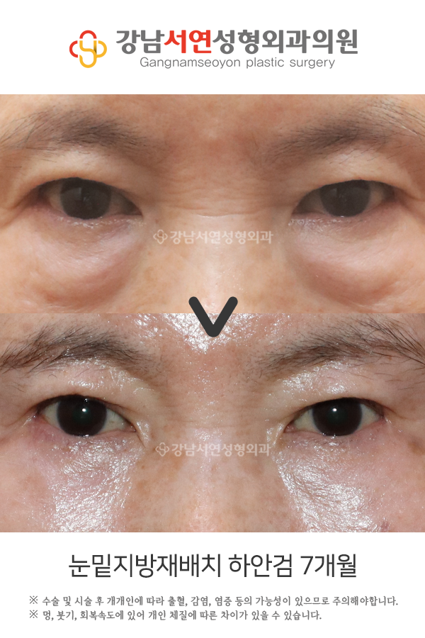 하안검 회복기간, 수술 방법별로 다릅니다 — 단계별 완전 정리 사진 3