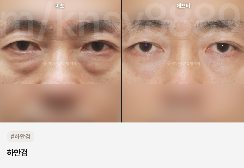 하안검 회복기간, 수술 방법별로 다릅니다 — 단계별 완전 정리 사진 6