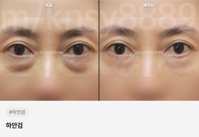 하안검 회복기간, 수술 방법별로 다릅니다 — 단계별 완전 정리 사진 7