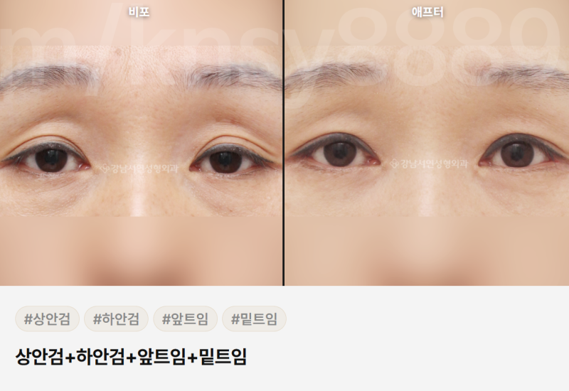 중년 눈성형 잘하는곳, 어떻게 골라야 할까요? 사진 6