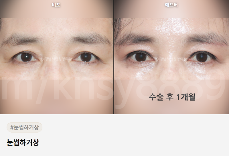 중년 눈성형 잘하는곳, 어떻게 골라야 할까요? 사진 3