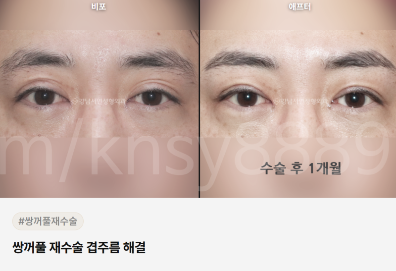 눈꺼풀 주름 개선, 원인이 다르면 치료법도 달라집니다 사진 2