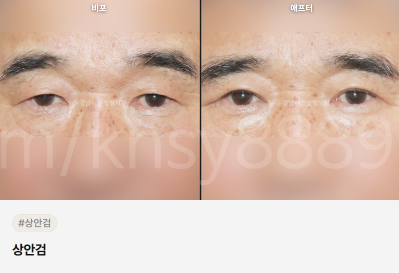 하안검 뜻, 정확히 무엇인지 알기 쉽게 정리했습니다 사진 7