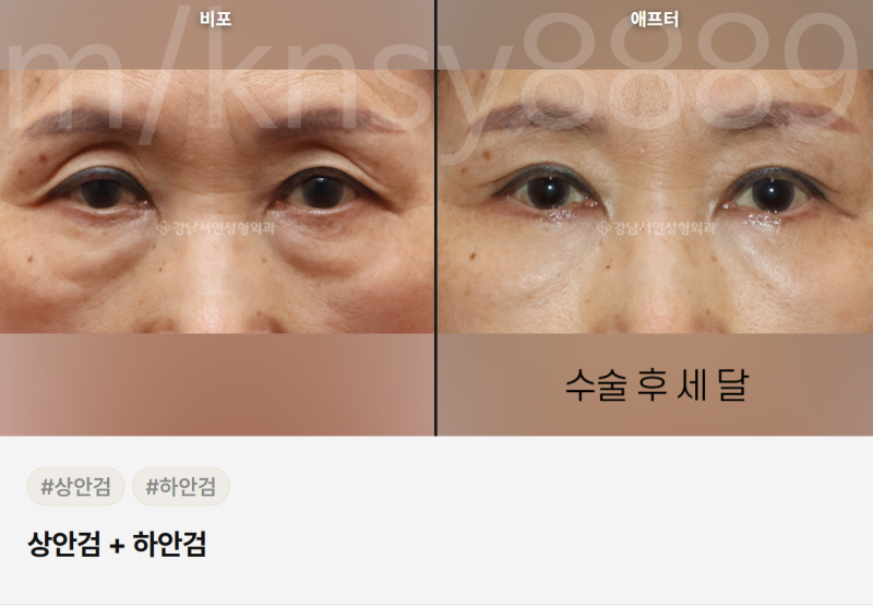 하안검 뜻, 정확히 무엇인지 알기 쉽게 정리했습니다 사진 11