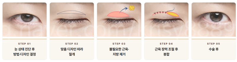 무쌍 눈매교정술, 쌍꺼풀 없이 눈매를 또렷하게 만들 수 있나요? 사진 10