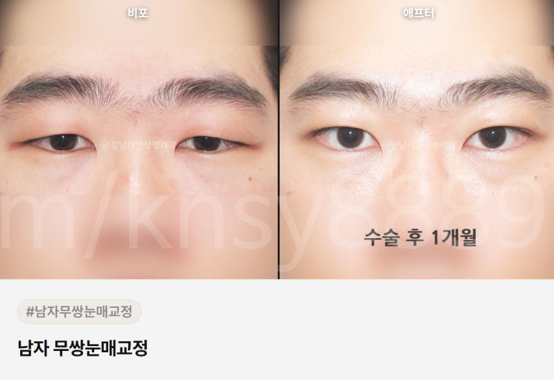 무쌍 눈매교정술, 쌍꺼풀 없이 눈매를 또렷하게 만들 수 있나요? 사진 6
