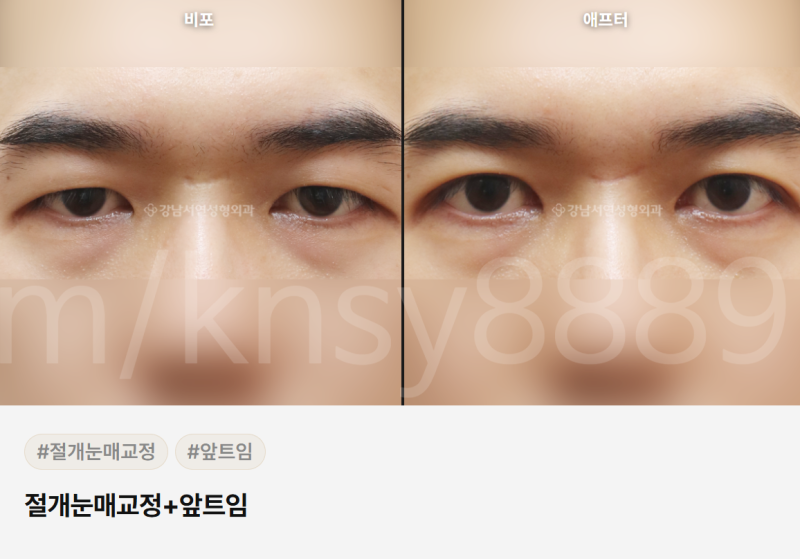 무쌍 눈매교정술, 쌍꺼풀 없이 눈매를 또렷하게 만들 수 있나요? 사진 11