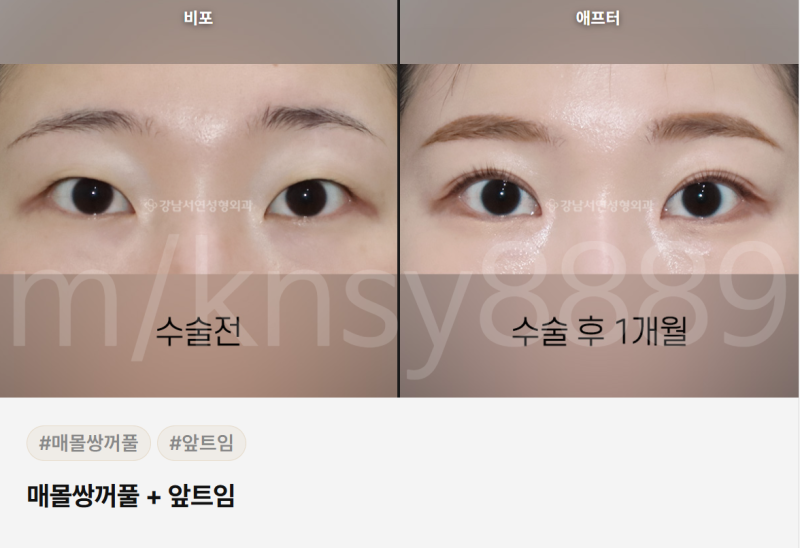 쌍수 매몰 절개 차이점, 처음 알아보는 분도 이 글 하나로 이해됩니다 사진 4