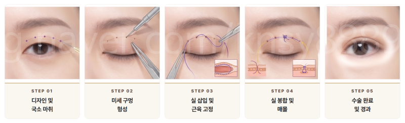쌍수 매몰 절개 차이점, 처음 알아보는 분도 이 글 하나로 이해됩니다 사진 3