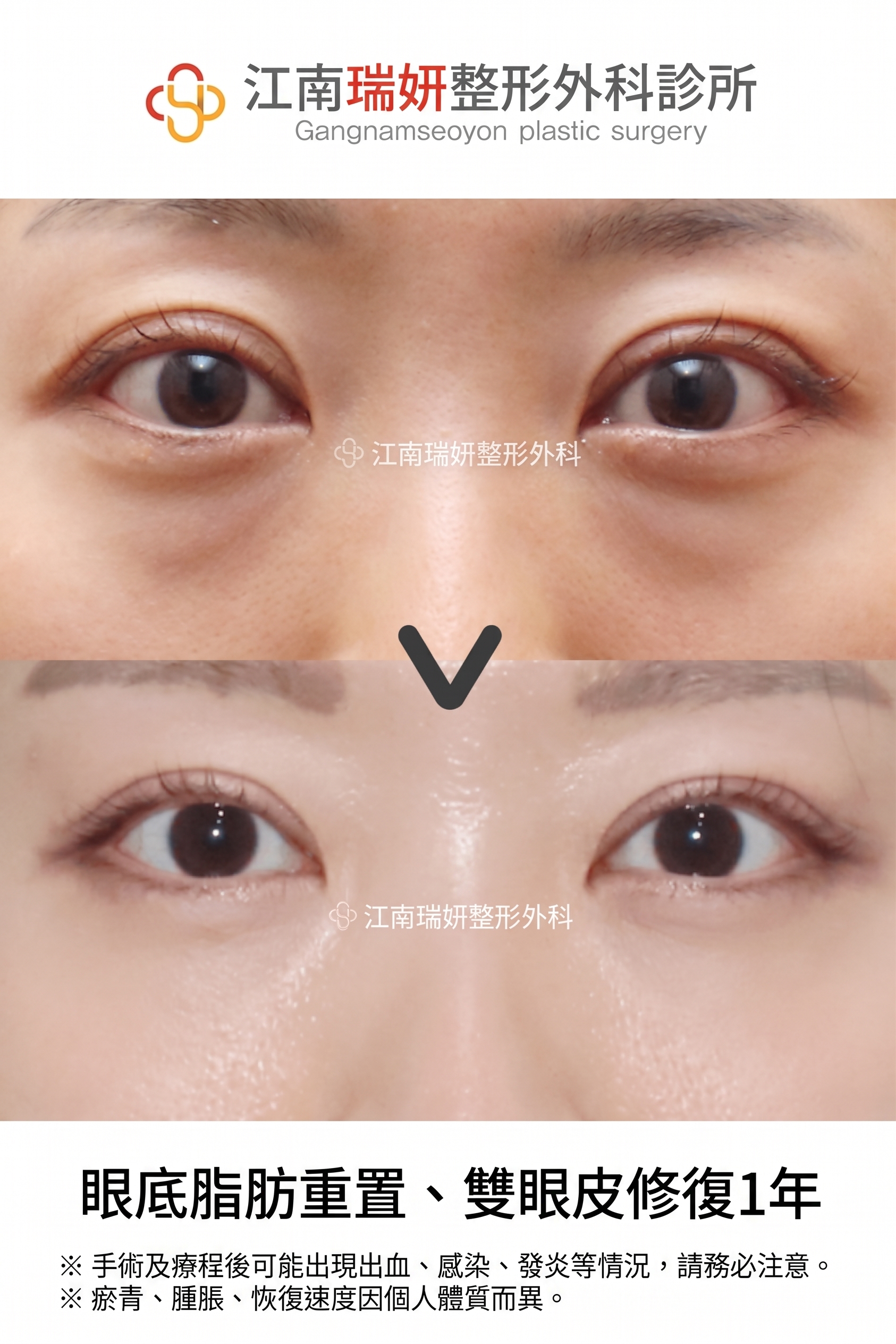 雙眼皮降窄手術(雙線法),與單線法有何不同? 사진 13