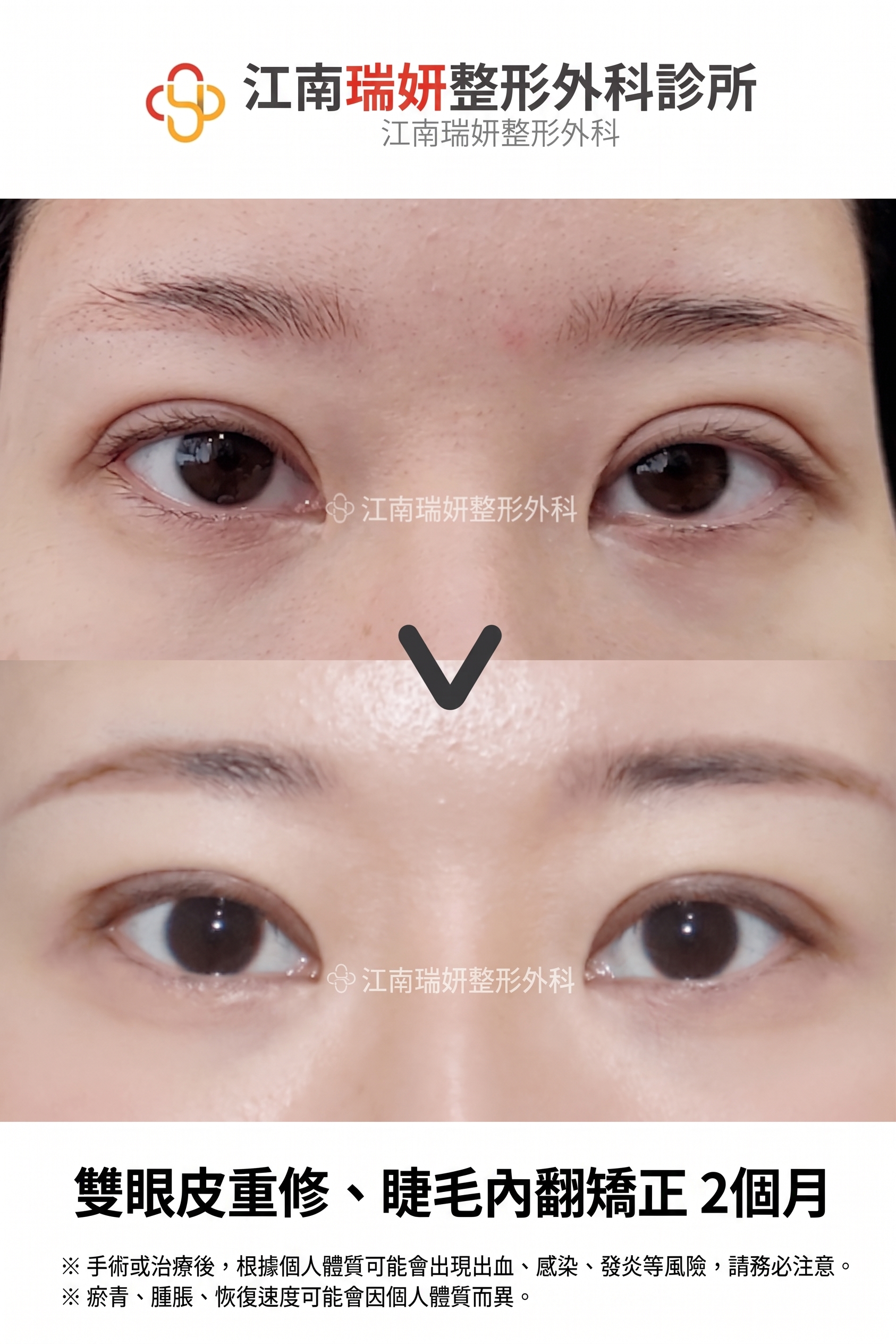 雙眼皮降窄手術(雙線法),與單線法有何不同? 사진 4