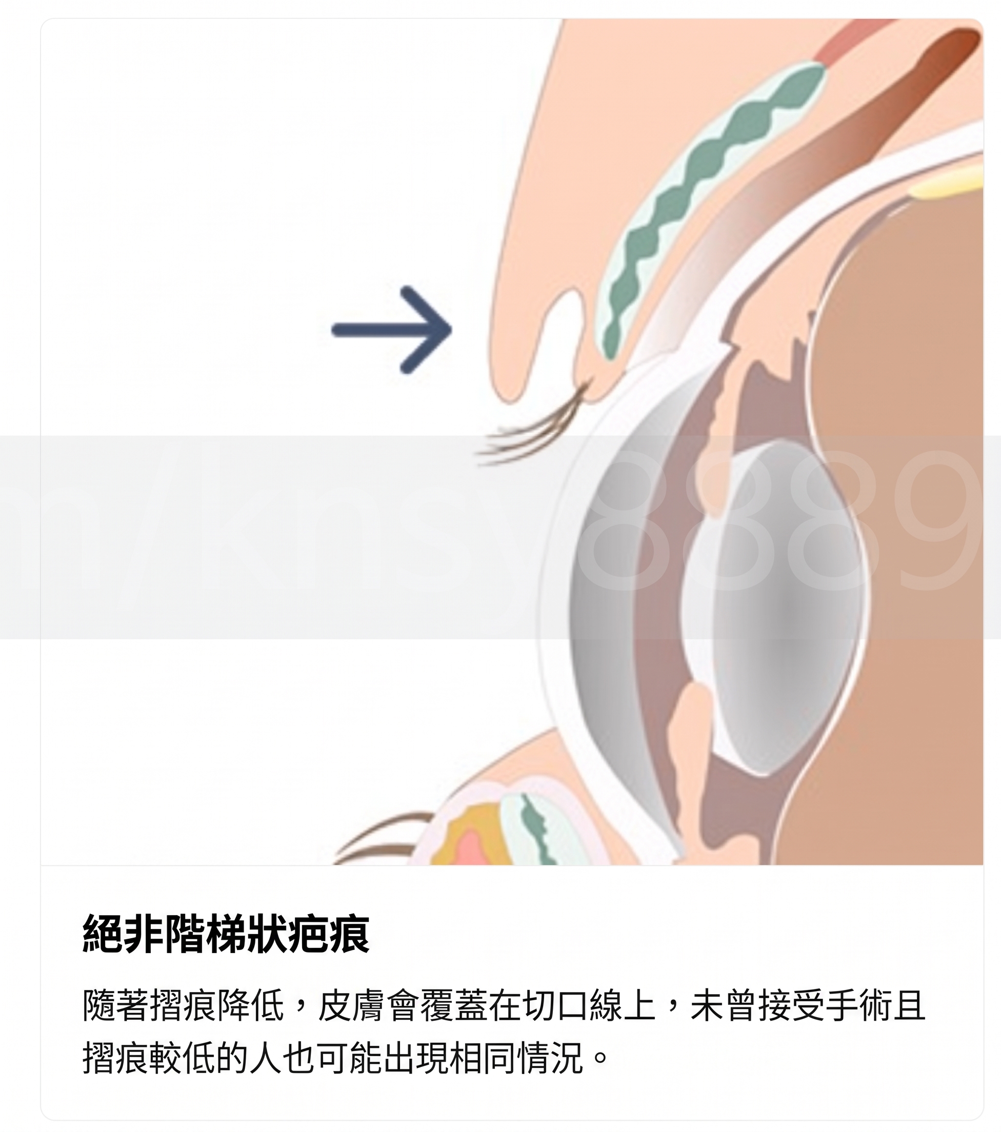 雙眼皮降窄手術(雙線法),與單線法有何不同? 사진 11