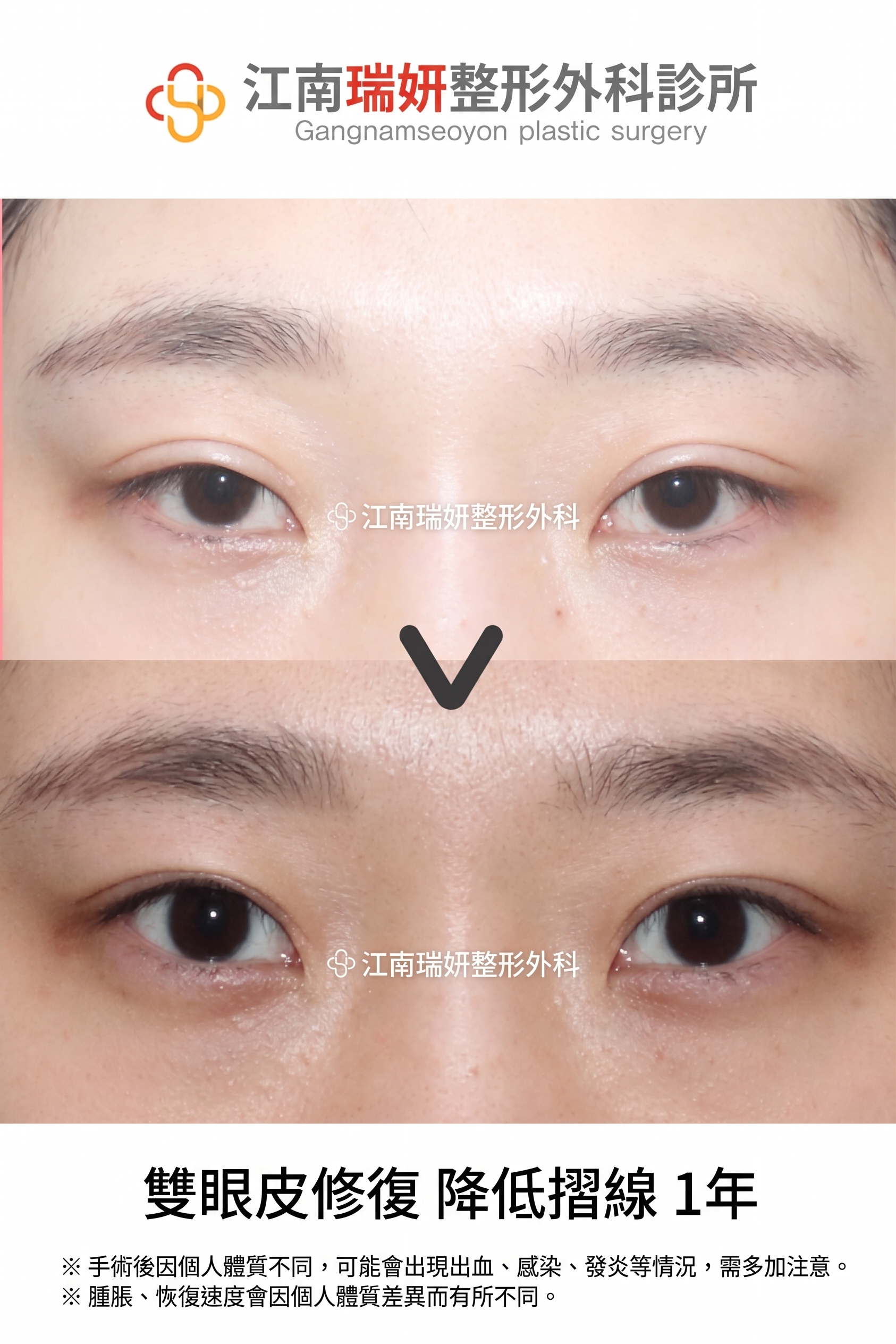 雙眼皮降窄手術(雙線法),與單線法有何不同? 사진 12