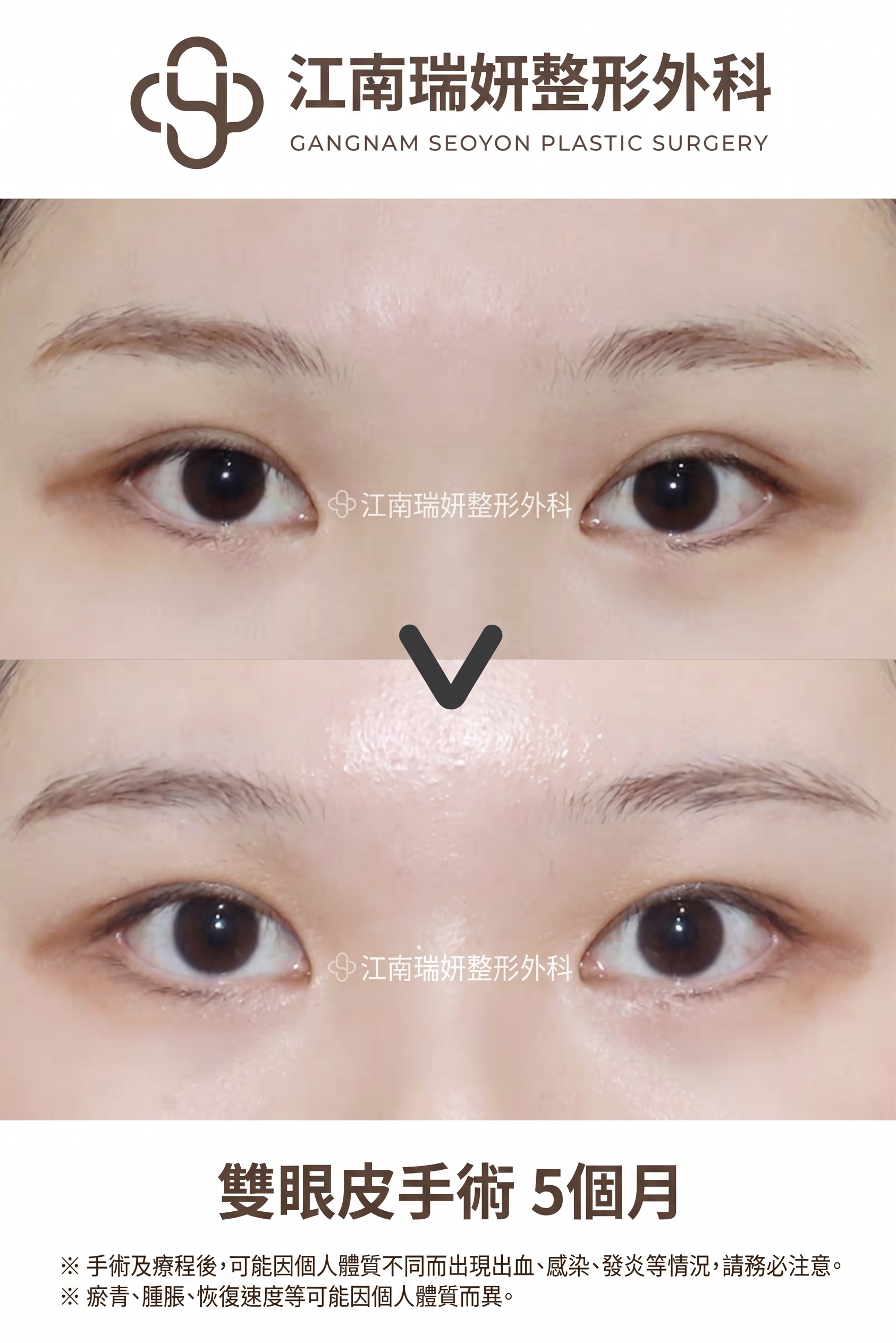 雙眼皮降窄手術(雙線法),與單線法有何不同? 사진 2