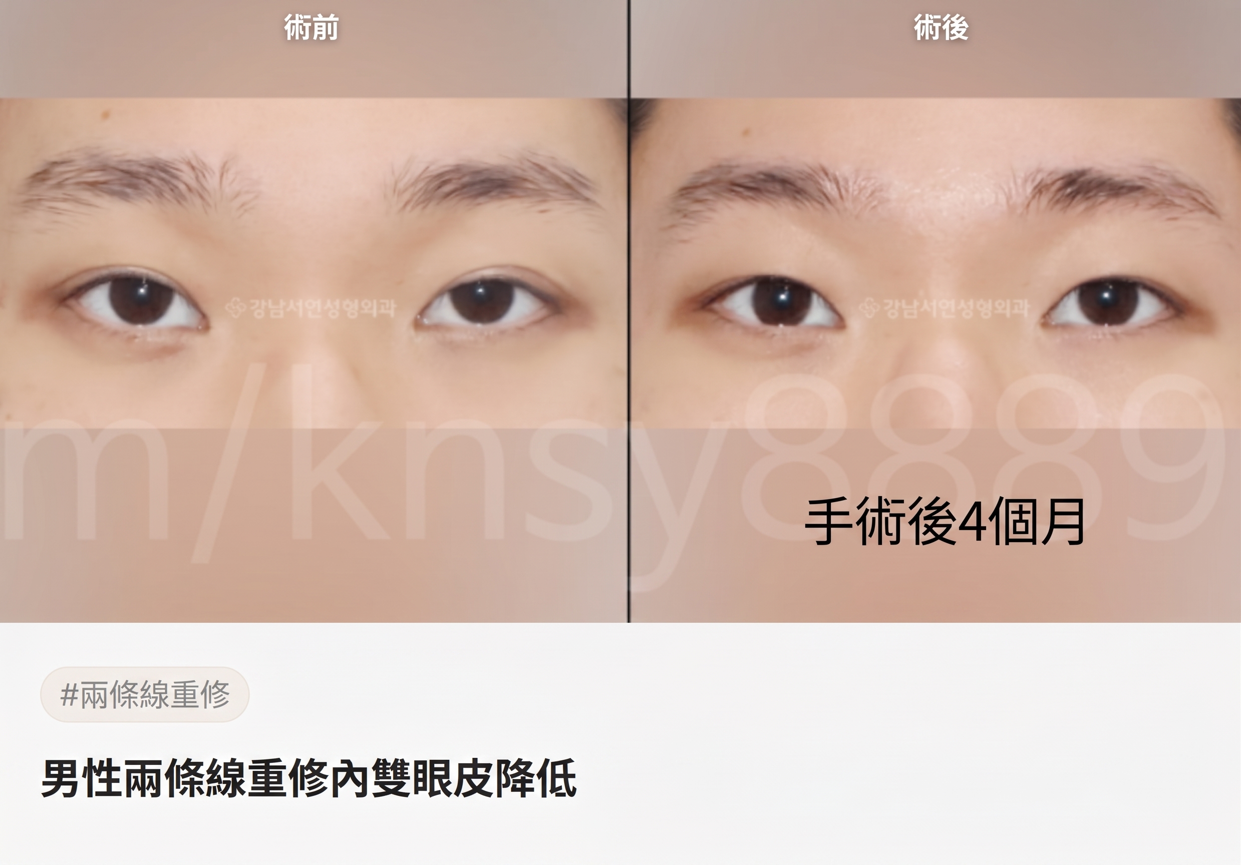 雙眼皮降窄手術(雙線法),與單線法有何不同? 사진 10