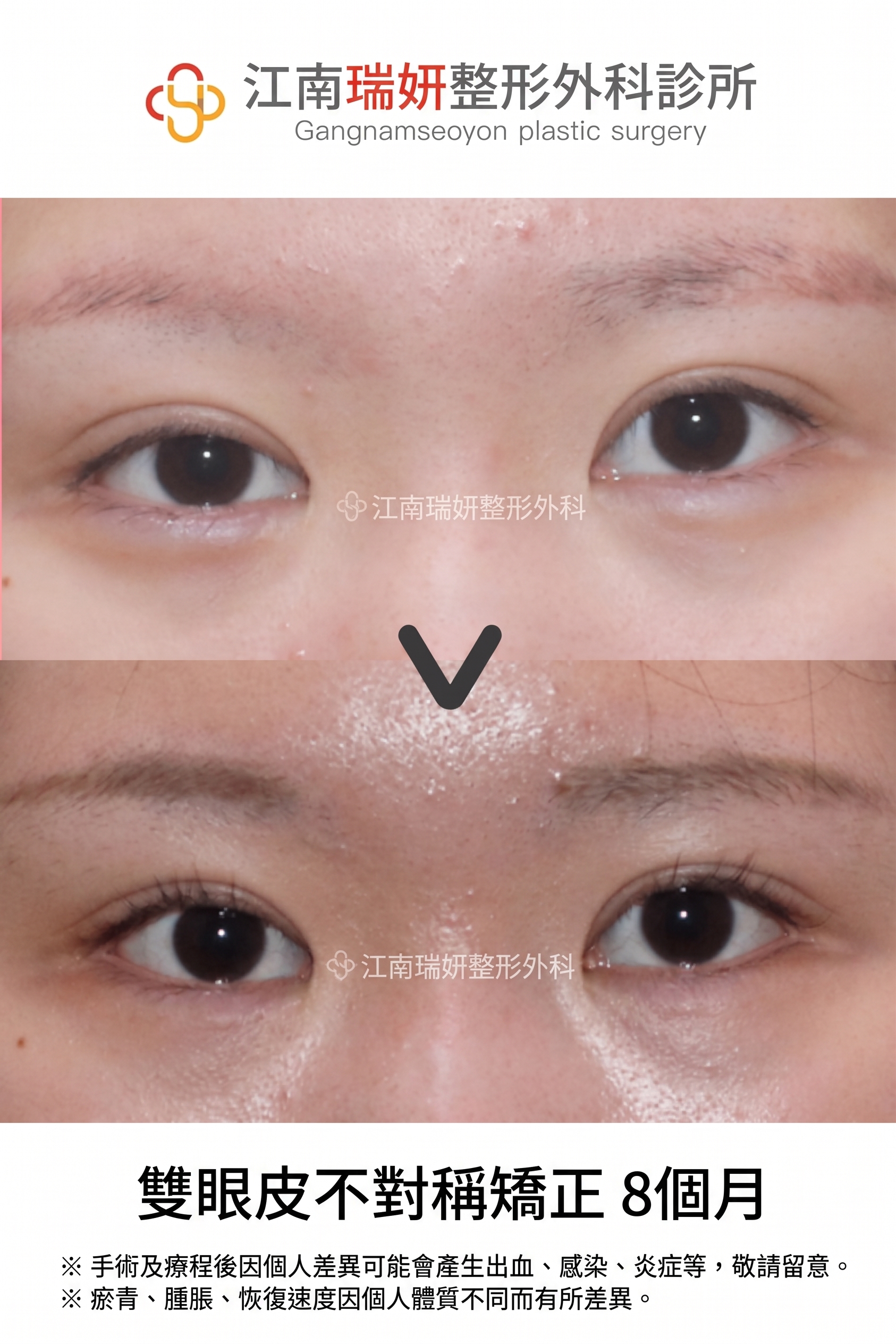 雙眼皮降窄手術(雙線法),與單線法有何不同? 사진 3