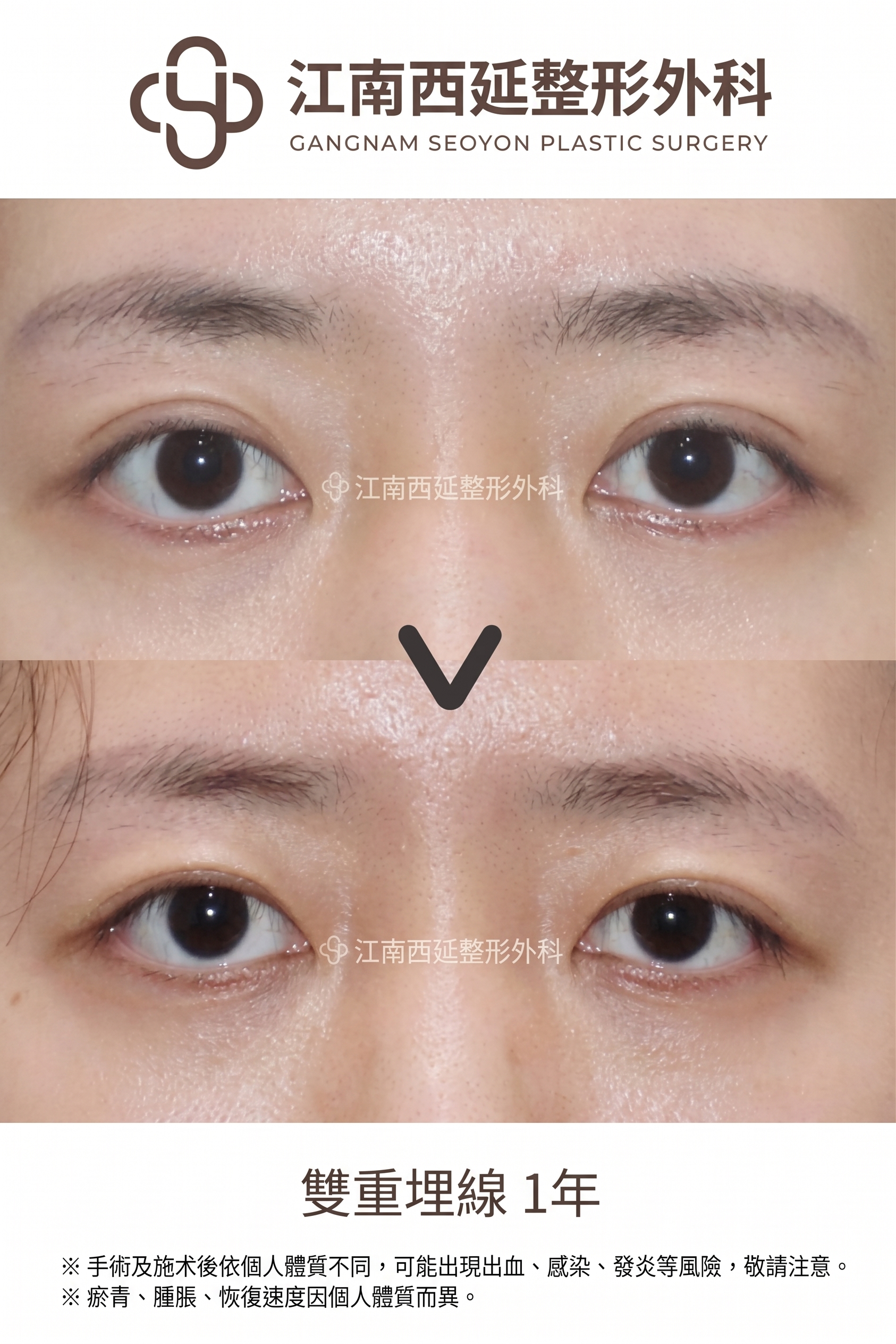雙眼皮降窄手術(雙線法),與單線法有何不同?