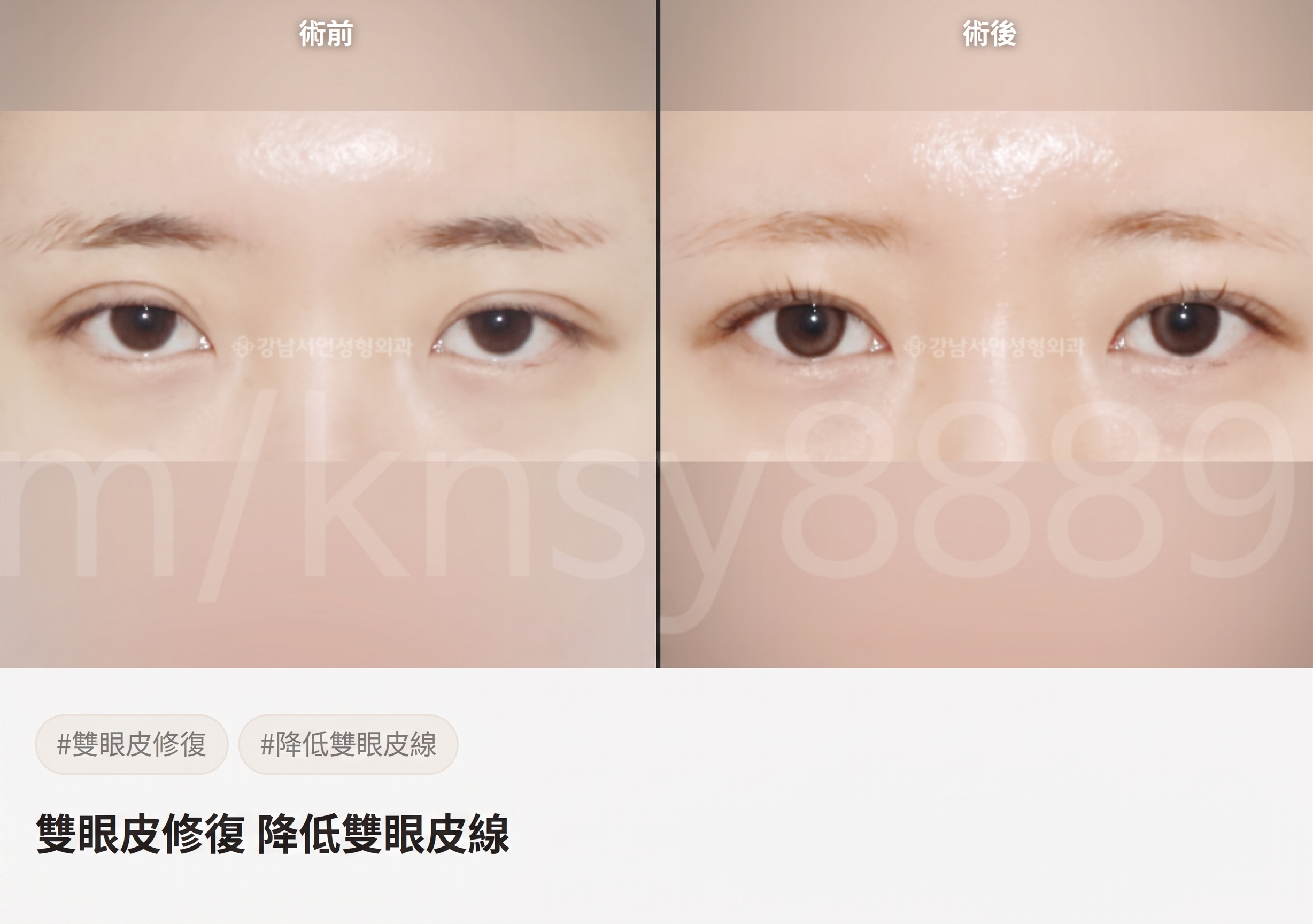 雙眼皮降窄手術(雙線法),與單線法有何不同? 사진 9