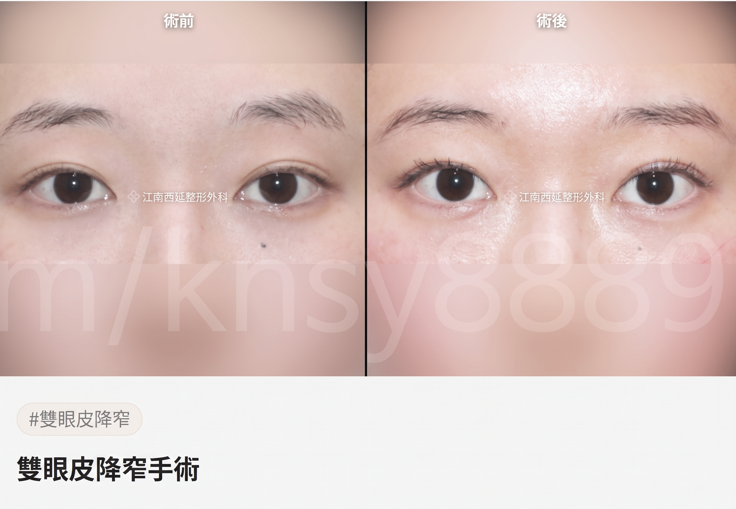 雙眼皮降窄手術(雙線法),與單線法有何不同? 사진 7