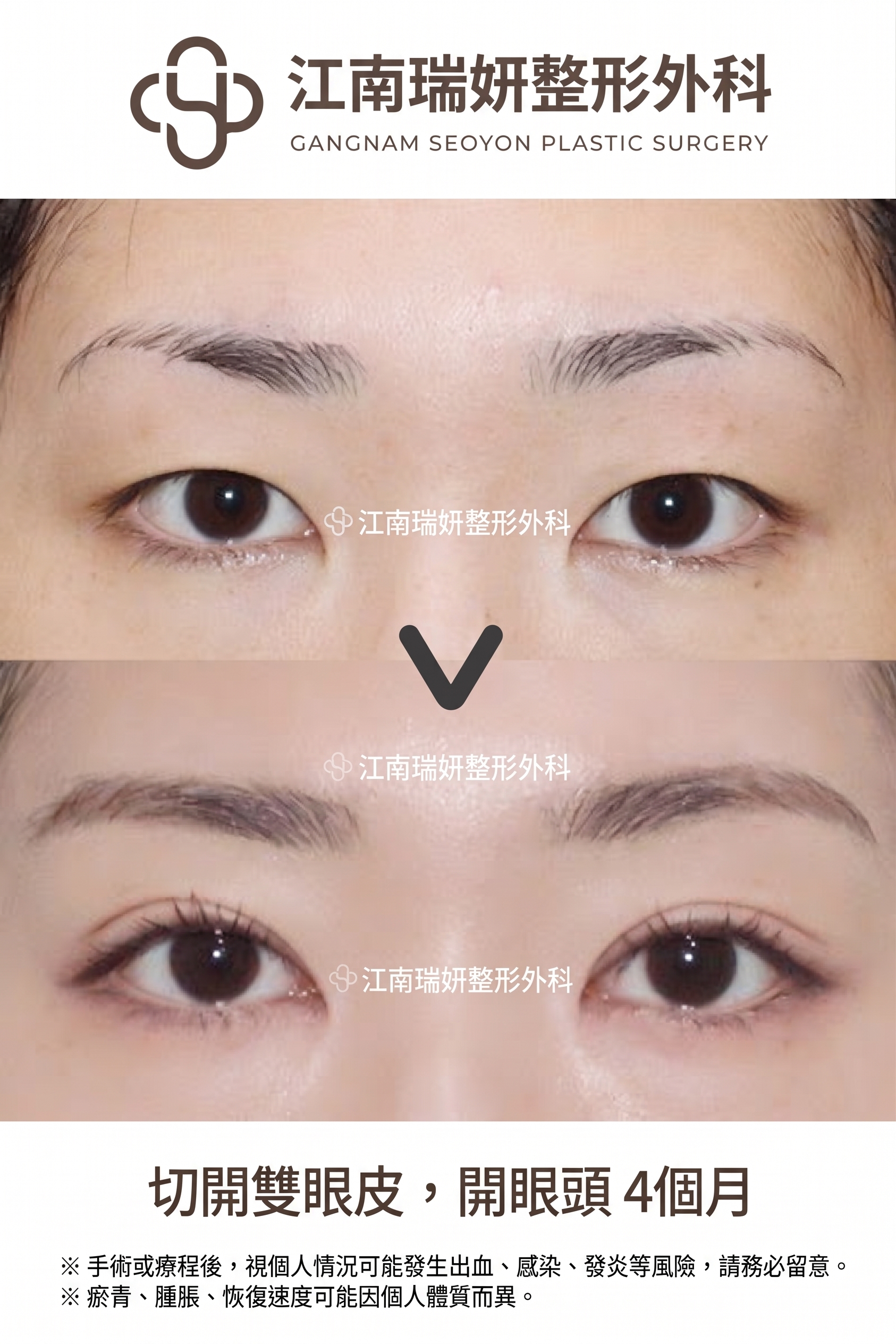 割雙眼皮鬆脫的原因，即使是割雙眼皮也會因縫合方式不同而有所差異 사진 3