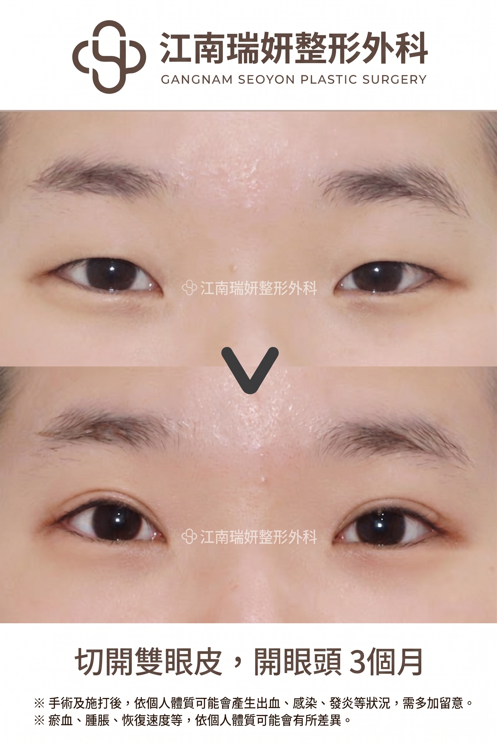 割雙眼皮鬆脫的原因，即使是割雙眼皮也會因縫合方式不同而有所差異 사진 7