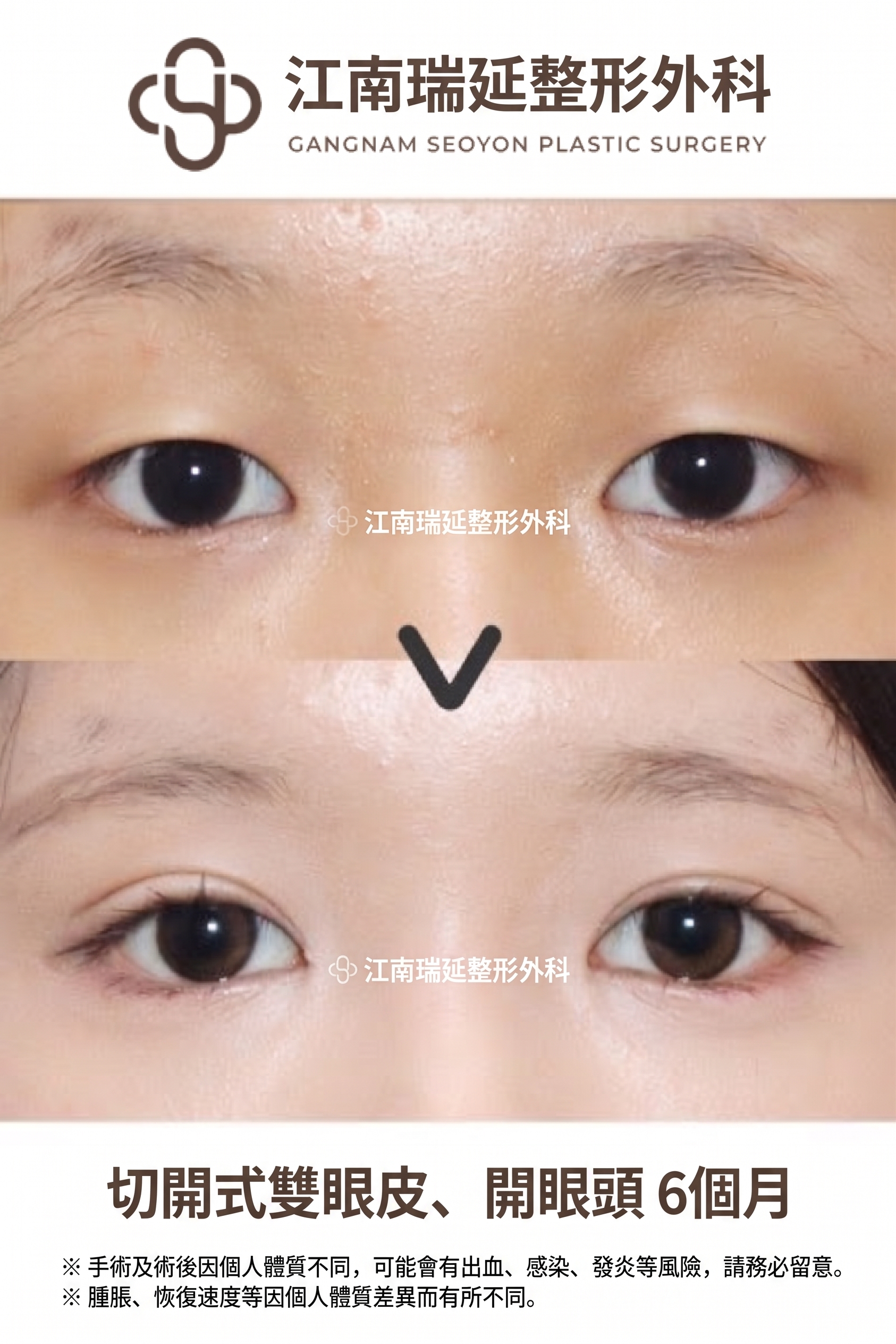 割雙眼皮鬆脫的原因，即使是割雙眼皮也會因縫合方式不同而有所差異
