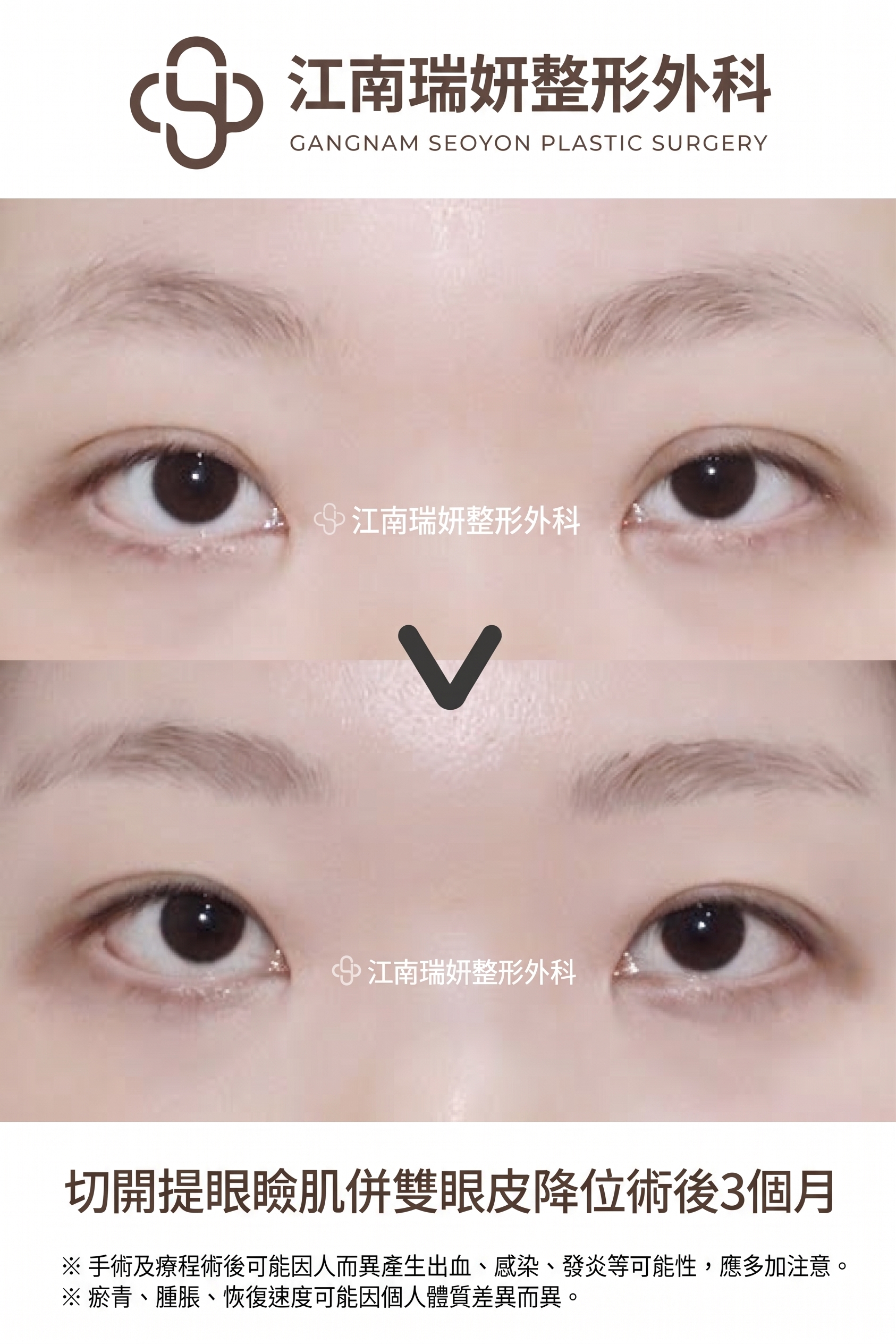 割雙眼皮鬆脫的原因，即使是割雙眼皮也會因縫合方式不同而有所差異 사진 10