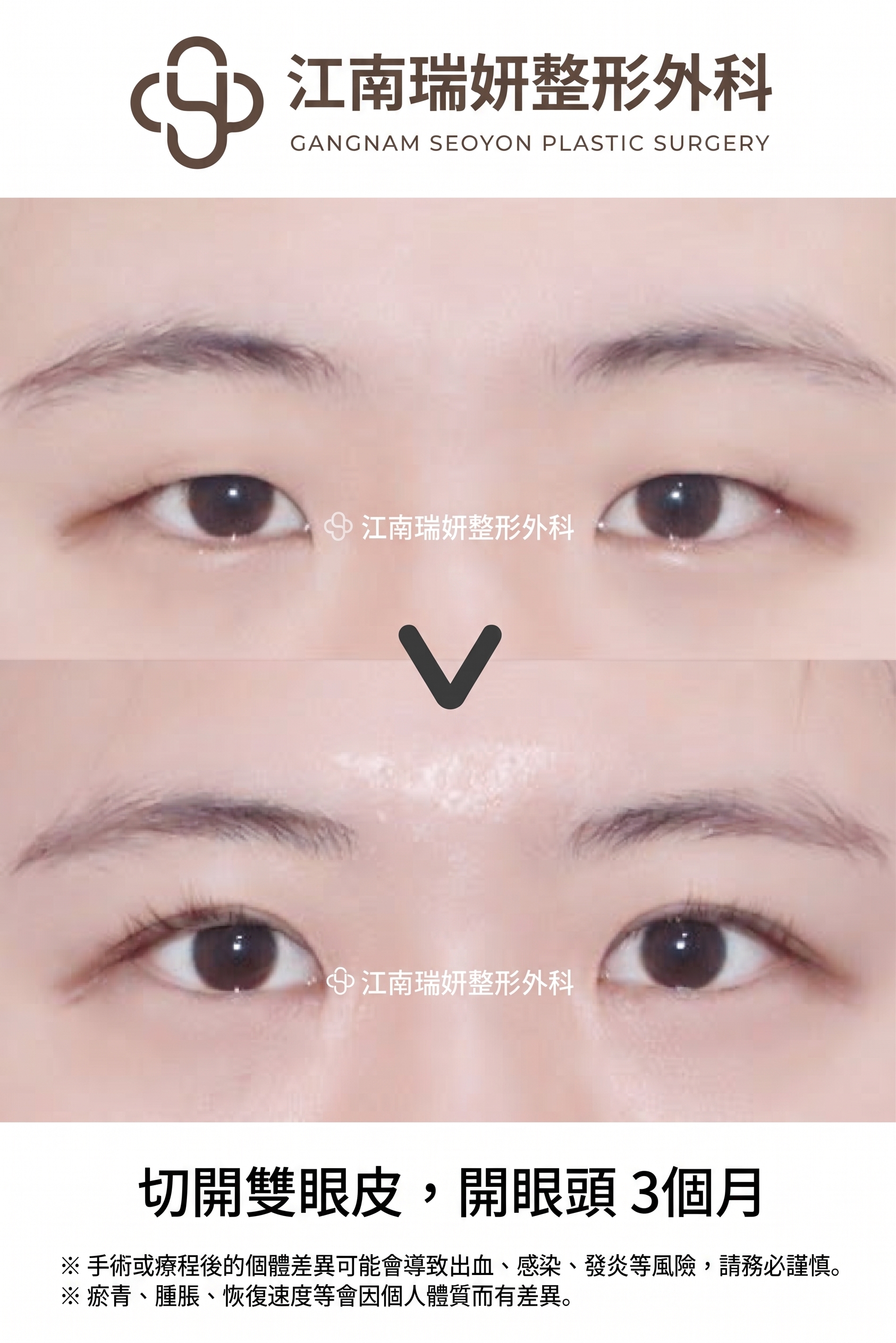 割雙眼皮鬆脫的原因，即使是割雙眼皮也會因縫合方式不同而有所差異 사진 6
