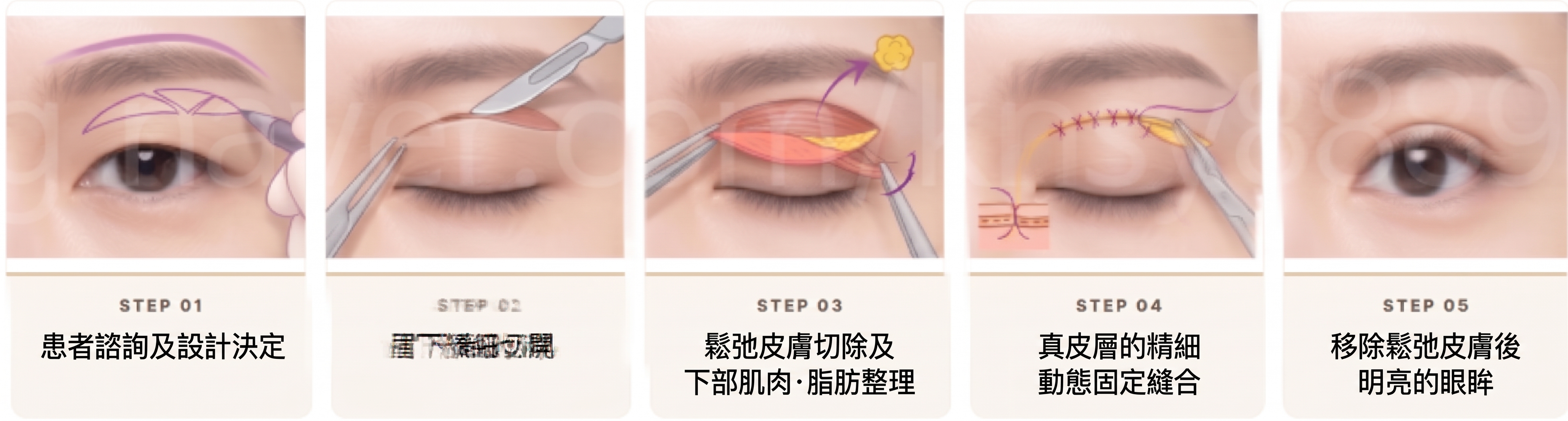 割雙眼皮鬆脫的原因，即使是割雙眼皮也會因縫合方式不同而有所差異 사진 5