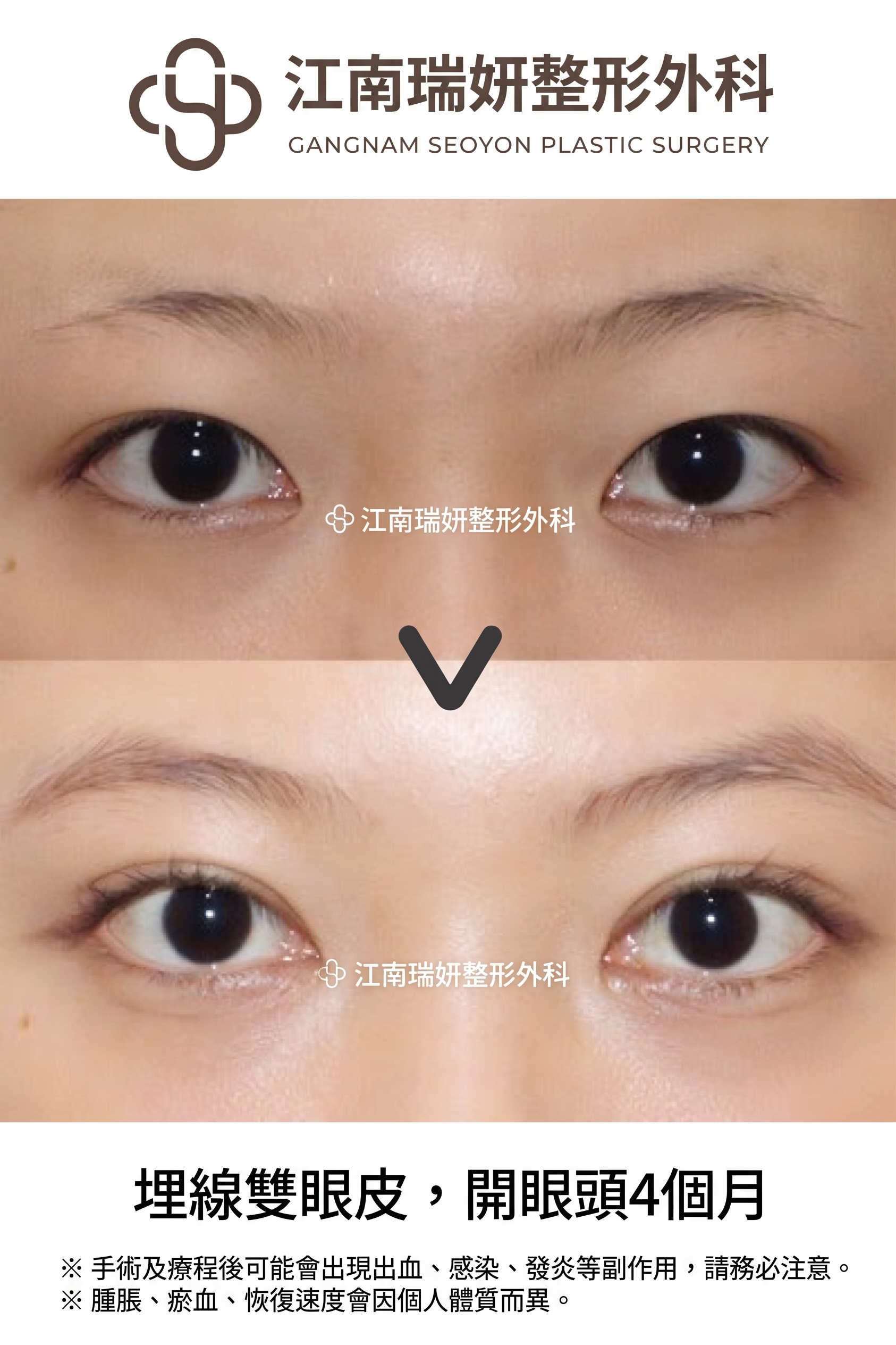 割雙眼皮鬆脫的原因，即使是割雙眼皮也會因縫合方式不同而有所差異 사진 2