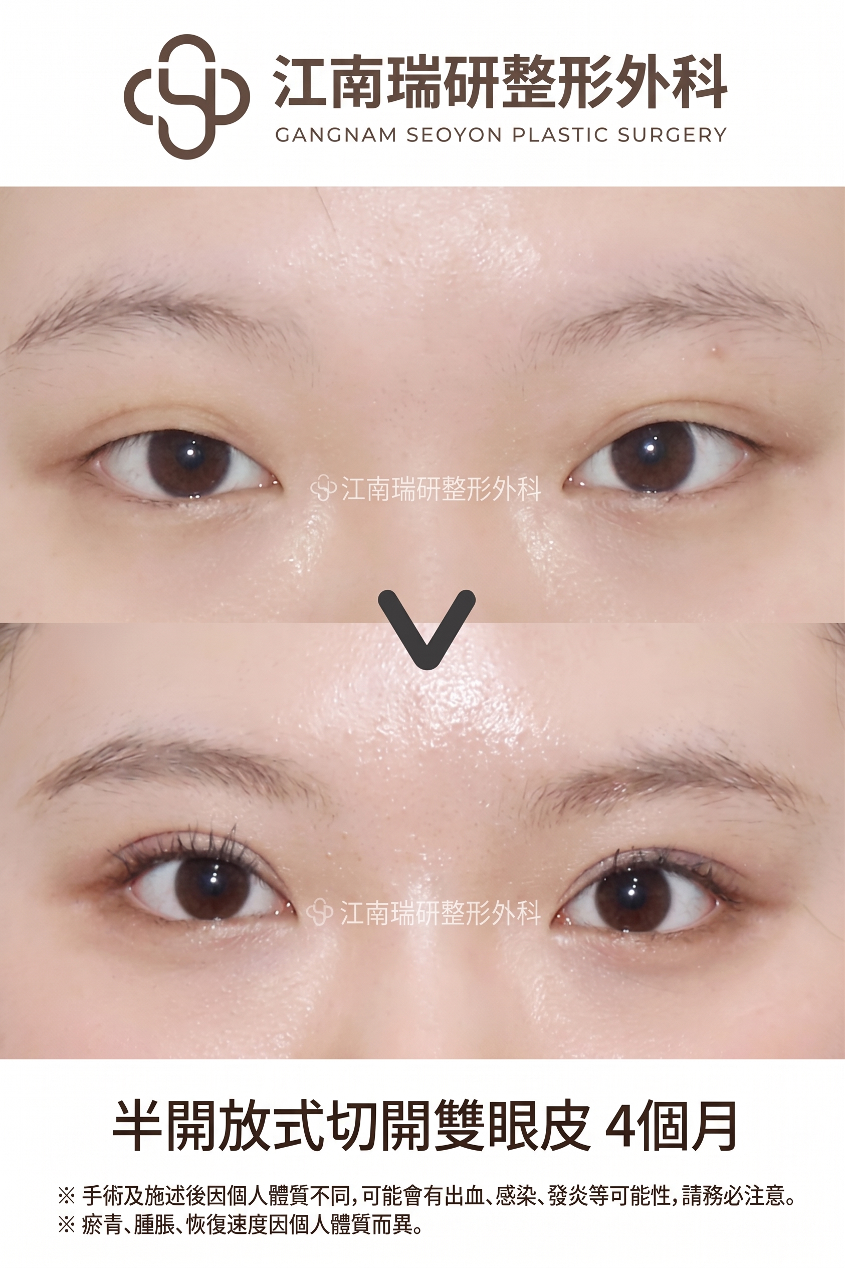 割雙眼皮鬆脫的原因，即使是割雙眼皮也會因縫合方式不同而有所差異 사진 4