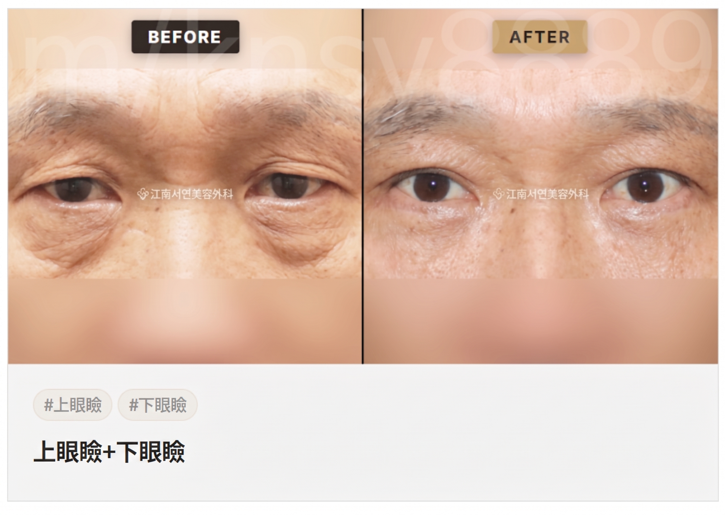 下眼瞼手術（目の下のたるみ取り）が適している場合とは？どのような目の下の状態なら検討できる？ 사진 9
