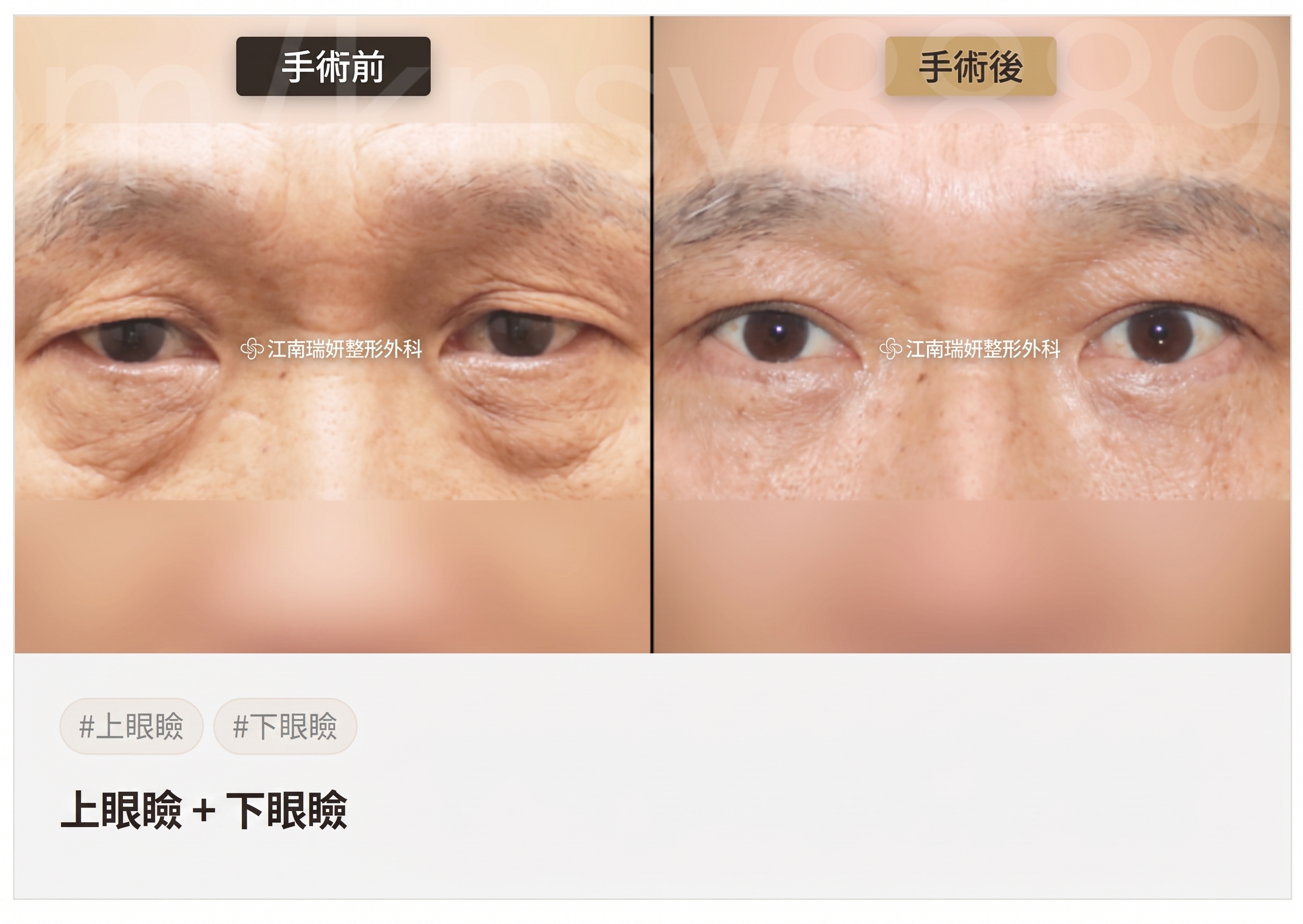 適合下眼瞼手術的情況：在何種眼下狀態下可以考慮？ 사진 9