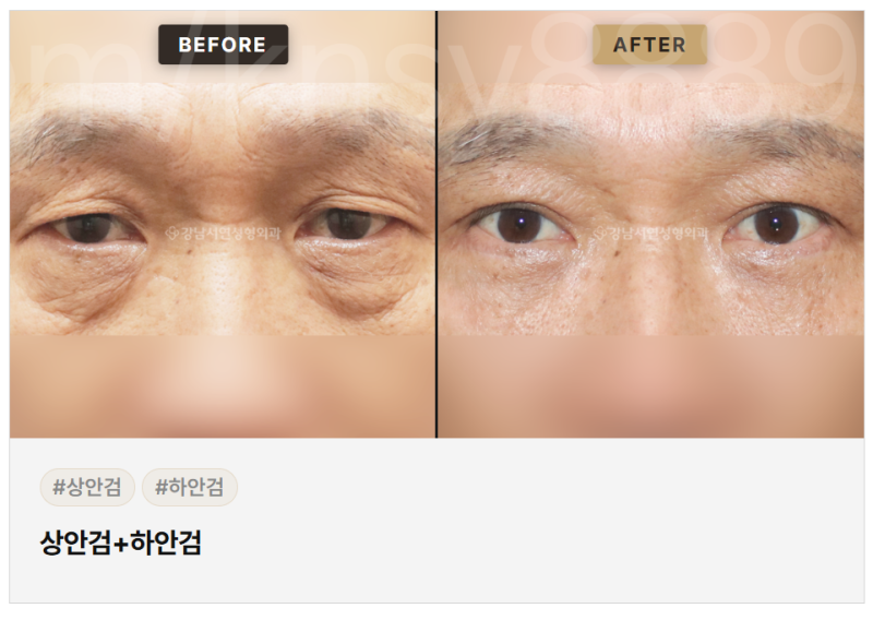 하안검 수술 적합한 경우, 어떤 눈밑 상태에서 고려할 수 있을까요? 사진 9