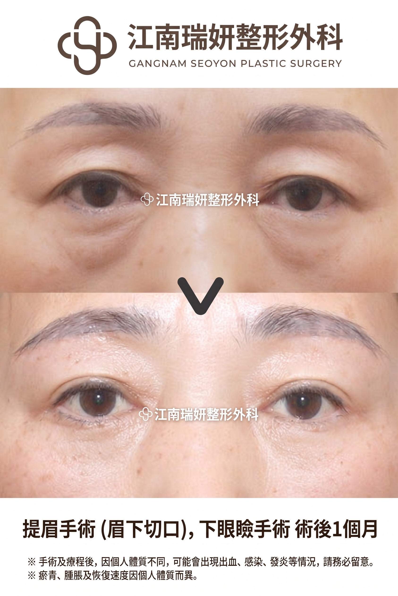 適合下眼瞼手術的情況：在何種眼下狀態下可以考慮？ 사진 2