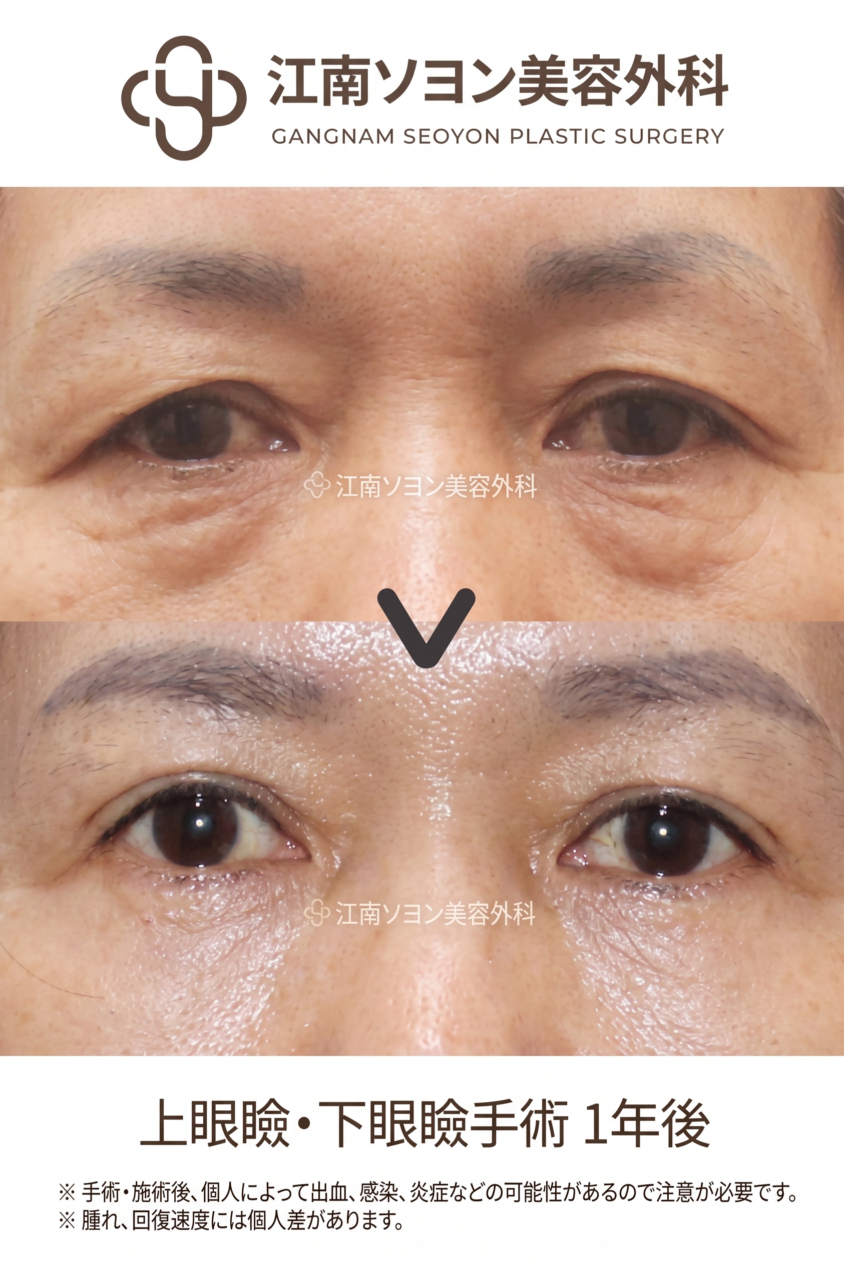 下眼瞼手術（目の下のたるみ取り）が適している場合とは？どのような目の下の状態なら検討できる？ 사진 7