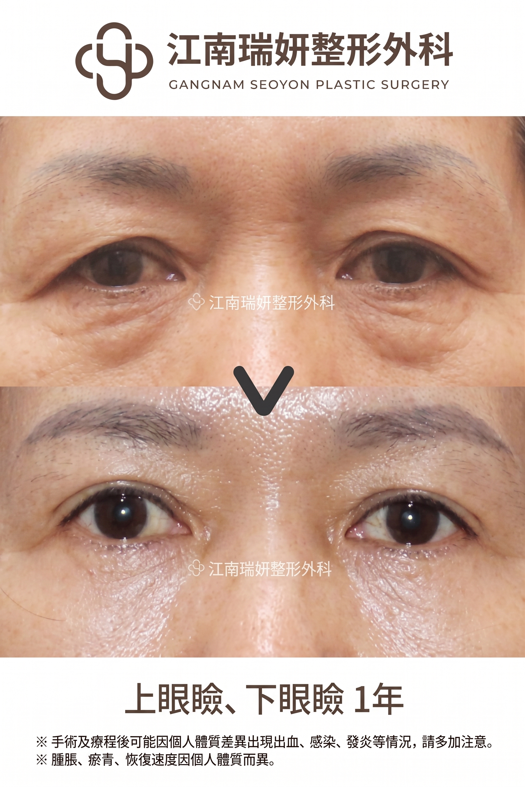 適合下眼瞼手術的情況：在何種眼下狀態下可以考慮？ 사진 7