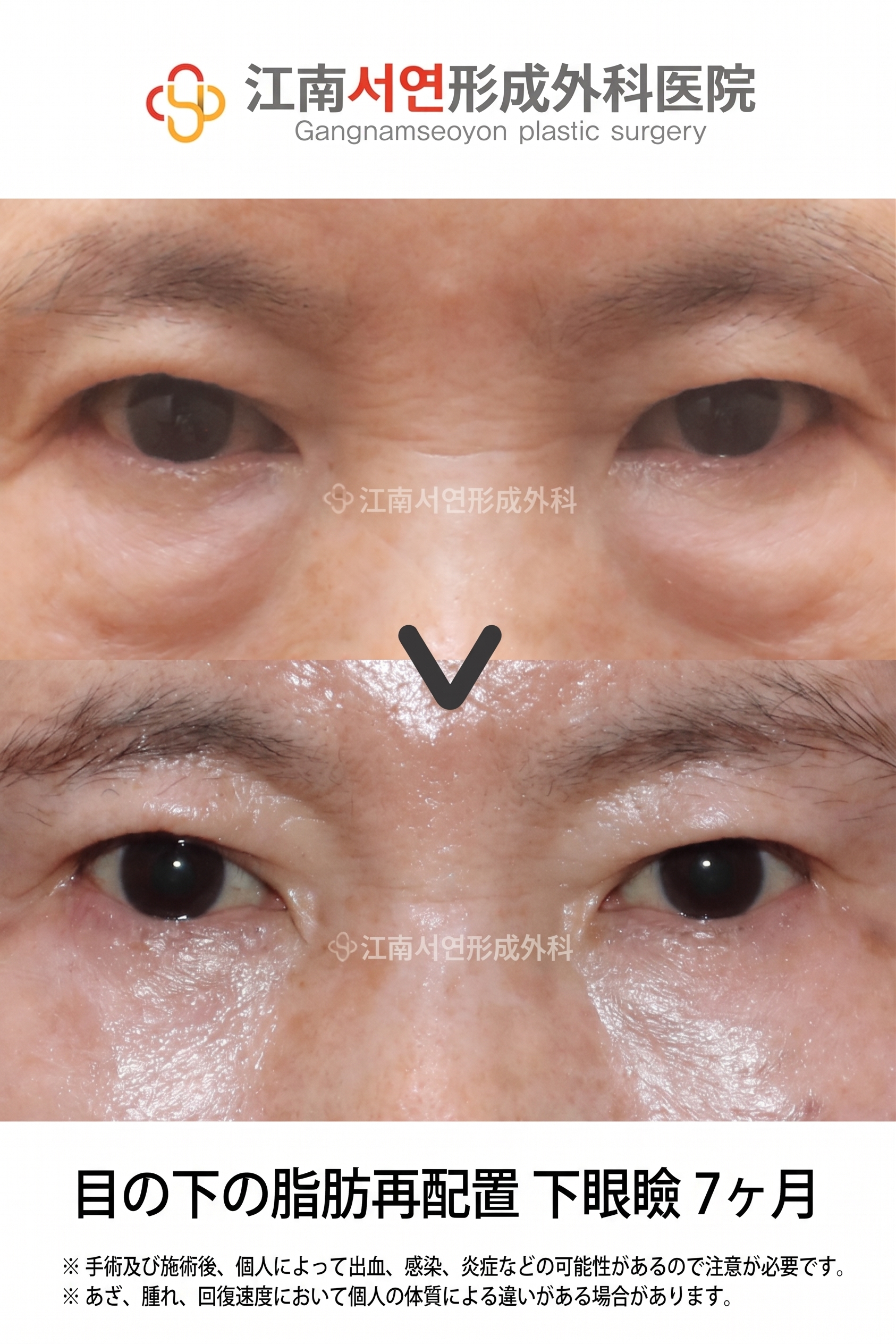下眼瞼手術（目の下のたるみ取り）が適している場合とは？どのような目の下の状態なら検討できる？ 사진 6