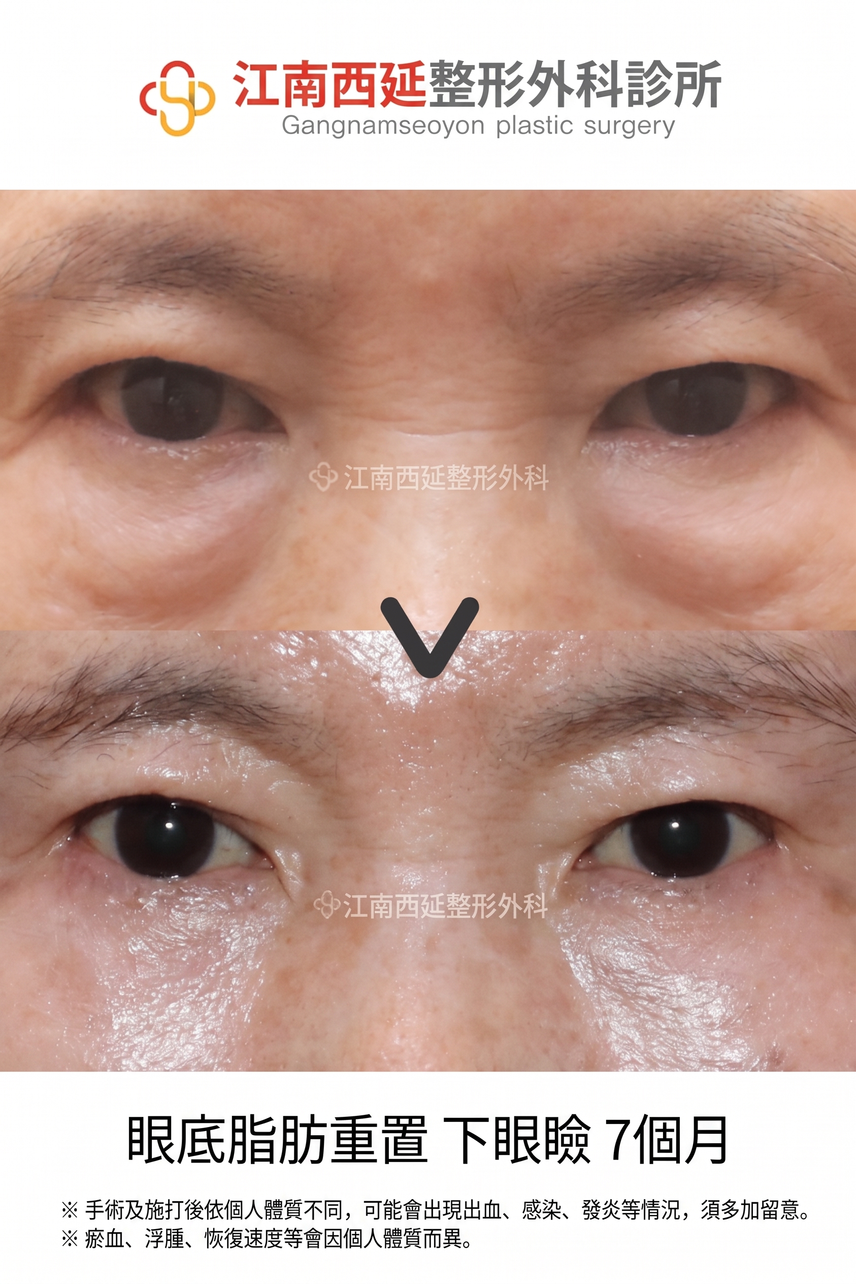 適合下眼瞼手術的情況：在何種眼下狀態下可以考慮？ 사진 6